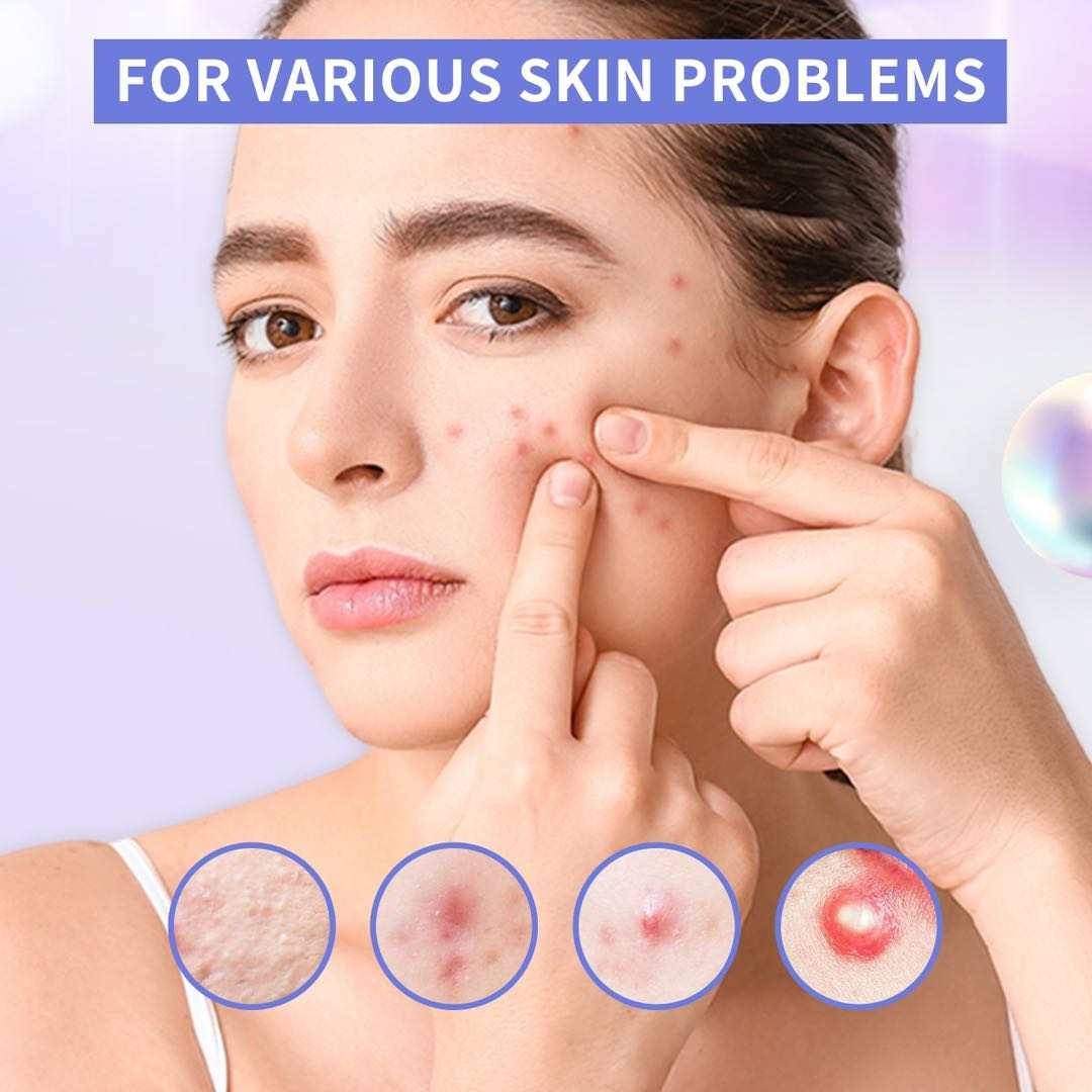 Nova Cosmetics Acne Pimple Patches